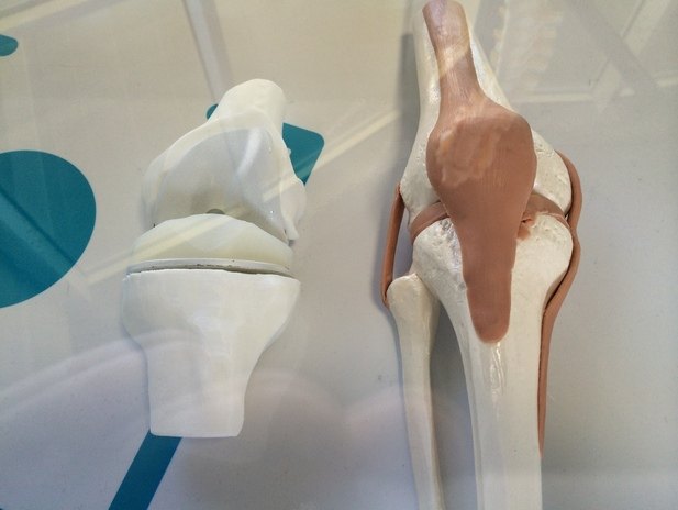 膝关节假体3d打印模型