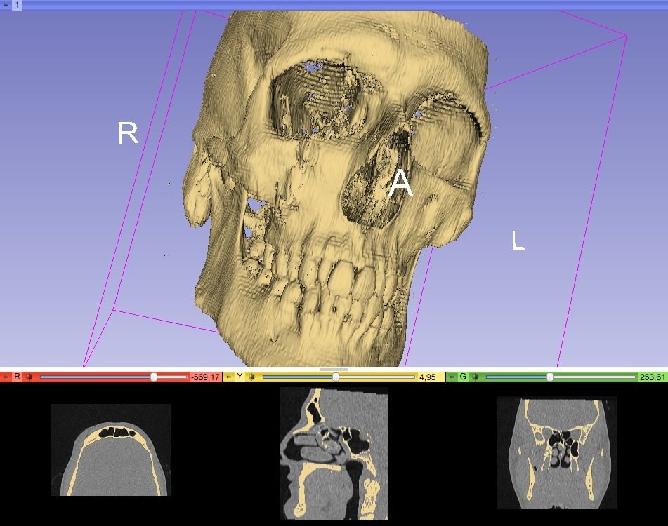 由CT数据创建的头骨 by rourou12 3D打印模型